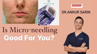 Facts about micro needling  Acne Scar Treatment  Dermapen 4  Morpheus 8 Dermaroller Dr Ankur [upl. by Jemina421]