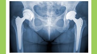 What is Hip Arthroplasty  shorts [upl. by Eelek]