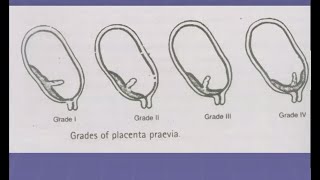 Antepartum Haemorrhage Lecture in Hindi  APH in Pregnancy  causes  Obstetrics and Gynecology OBS [upl. by Gally]