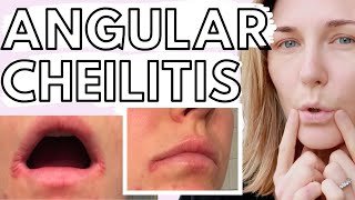 THE PAINFUL LIP  ANGULAR CHEILITIS [upl. by Chinua189]