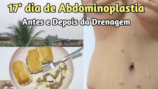 17° dia de Abdominoplastia [upl. by Oluas]