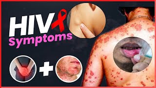 Early Signs of HIV AIDS in Men and Women  HIV Positive Signs [upl. by Narda723]