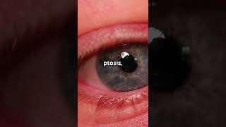 HornersSyndrome Neurology medicaleducation medicalstudent  DiagnosticLens [upl. by Aimar]