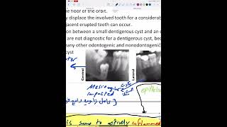 Odontogenic cysts 1 part 1 [upl. by Moina]