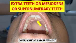 SUPERNUMERARY TEETH MESIODENS EXTRA TEETH COMPLICATIONS AND TREATMENT dentalcafe4331 [upl. by Sully]