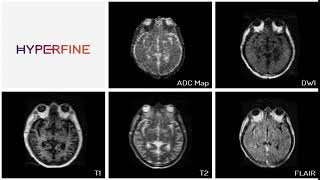 Middle Cerebral Artery Watershed Stroke [upl. by Wash]