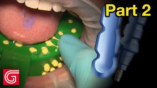 HOW TO Take Closed Tray Implant Impression for Tooth 19 [upl. by Ynots775]