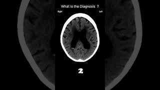 Subarachnoid haemorrhage  Ventricular blood Acute CT Brain Extraaxial 67 radiologychannel007 [upl. by Suilenroc885]