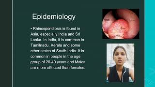 Rhinosporidiosis  The Infectious Fungal Disease [upl. by Tessy]