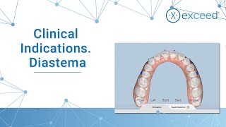 Clinical Indications Diastema [upl. by Ardnasak]