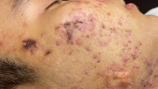 ACNE TREATMENT VU QUYNH MI  Blackheads Of Tweens 2024 EX [upl. by Laird]