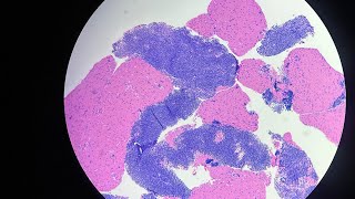 Mediastinal Thymoma with Lung Invasion Diagnosed by EBUSPLBPeribronchialSmall Biopsy25th Video [upl. by Hayden464]