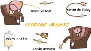 Comprendre le SONDAGE URINAIRE [upl. by Friedland466]