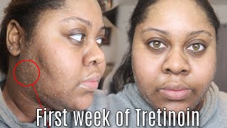 MY FIRST SEVEN DAYS USING TRETINOIN  Sherelle Saint Rose [upl. by Aeki]