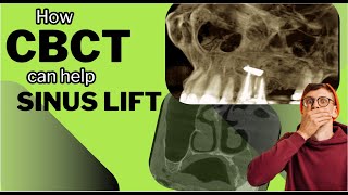 CBCT In Action Sinus Lift  Radiological evaluation of maxillary sinus anatomy before dental implant [upl. by Francis]