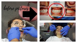 BRACES VLOG theyre coming off  before pics of my ugly teeth hehe [upl. by Ahsienat]