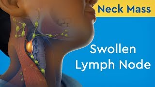 Neck Mass Swollen Lymph Node [upl. by Brause]