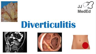 Diverticulitis Risk Factors ex Low Fiber Diets Symptoms Diagnosis Treatment and Complications [upl. by Byram]