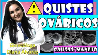 TODO sobre los QUISTES OVARICOS Causas Tratamiento por GINECOLOGA DIANA ALVAREZ [upl. by Niledam]