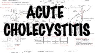 Acute Cholecystitis  Overview signs and symptoms pathophysiology treatment [upl. by Nolos]