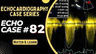 ECHO CASE 82  Echocardiography Spot Diagnosis Series  Echocardiogram Interpretation made easy [upl. by Adnaval]