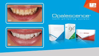 Professional Results with Opalescence™ teeth whitening [upl. by Sothena]