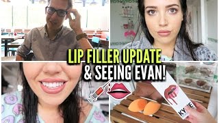 Lip Filler Update amp Seeing Evan [upl. by Annahtur]