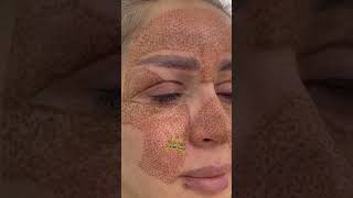 Fibroblastplasma fibroblastskintightening ترند fibroblasting skincare [upl. by Higley]