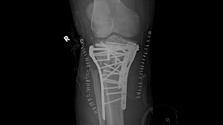 Three column classification of proximal tibiatibial plateau fractures explanation with examples [upl. by Meingolda]