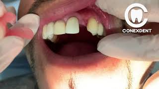 Prótesis Flexible de 1 diente SMILING CONEXDENT [upl. by Suhail403]