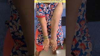 Best treatment for Lymphedema  Lymphedema Successful Treatment shorts lymphedema handswelling [upl. by Renaldo]