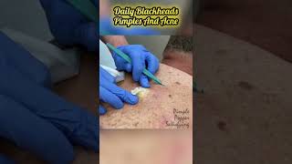 Cystic Acne Removal amp Inflammatory Acne [upl. by Annahsor519]