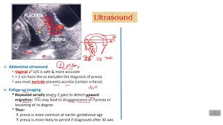 Antepartum hemorrhage  part 3 [upl. by Augy698]