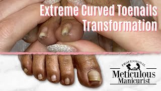 How To Trim Extreme Curved Toenails Pedicure Cleaning Tips [upl. by Jerroll]