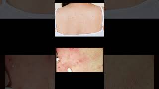 Back acne Pathology  Etiology  Pathogenesis  Clinical manifestations  Diagnosis amp Treatment [upl. by Gnilyarg]