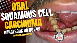 ORAL SQUAMOUS CELL CARCINOMA  HOW DANGEROUS OR LEATHAL IS IT  AN ORIGINAL CASE REPORT PART 1 [upl. by Eladnor]