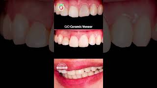 GiO Ceramic Veneer [upl. by Neelhtac]