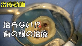 治らない？歯の根の治療 その１ 根管治療 隠れたもう１つの根管 [upl. by Gehlbach795]