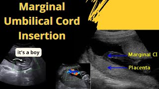 Ultrasound showing boy baby  with Marginal Umbilical Cord Insertion type [upl. by Mitchael609]