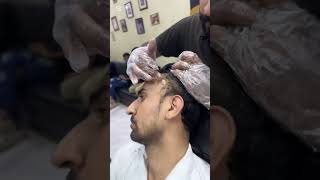 Hair alopecia treatment 😱❤️‍🩹 remix edm alopecia alopeciaareatatreatment hairlosstreatment [upl. by Westbrooke]