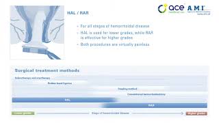 Hemorrhoid Treatment Options [upl. by Ransell817]