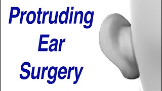 Protruding Ear Surgery Otoplasty Ear Pinning [upl. by Doomham]