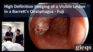 High Definition Imaging of a Visible Lesion in a Barretts Oesophagus [upl. by Jordain]