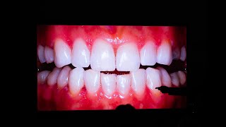 OPTIMIZACIÓN EN BLANQUEAMIENTO DENTAL [upl. by Yssirhc967]