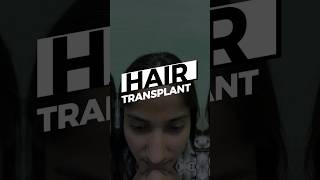 Hair Transplant hisar hairtransplant [upl. by Lexerd]