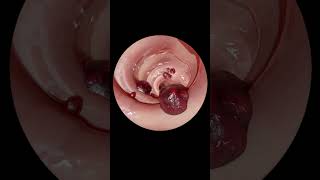 How gastrointestinal endoscopy is done [upl. by Crudden]