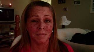 Skin Cancer My Vlogjournal Treatment W EFUDEX vid8 [upl. by Burck624]