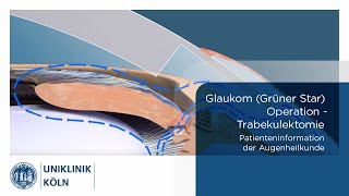 Glaukom Grüner Star OP  Trabekulektomie Patienteninformation Augenklinik  Uniklinik Köln [upl. by Ardna]