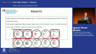 6 The relevance of the subtype posterior staphyloma in myopic maculopathy and visual prognosis [upl. by Mccreery]