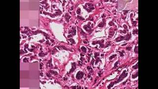 Histopathology LungBronchial carcinoid [upl. by Demmahum]